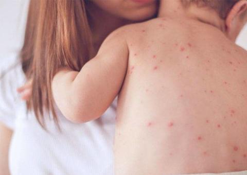 Sarampo avança no Brasil, e medo de coronavírus dificulta vacinação