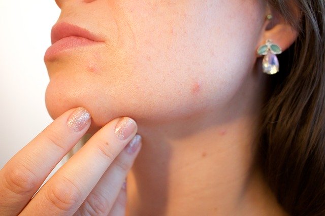 Aprenda a fazer hidratação na pele e evitar acnes