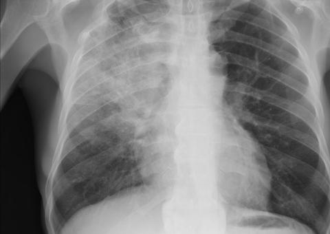 Especialistas sugerem aumento da testagem e descartam exames de imagem