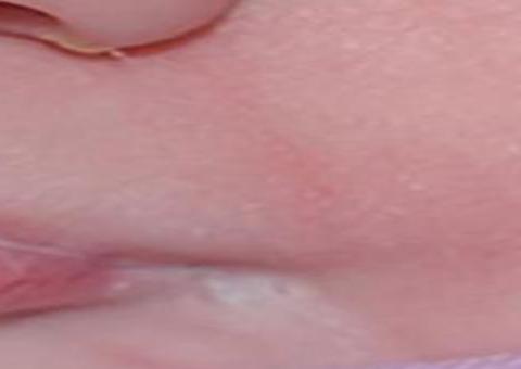 Bebê nasce com duas bocas e passa por cirurgia nos EUA 