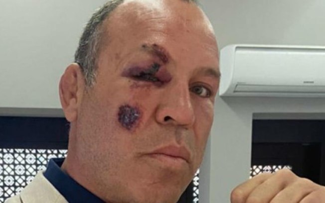 Lutador Wanderley Silva é arremessado em acidente durante passeio de bicicleta
