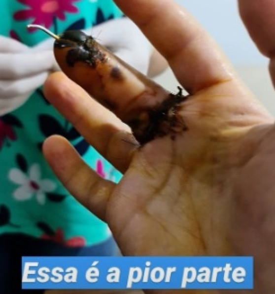 Caso Bilynskyj: delegado mostra dedo decepado: ‘pior parte’