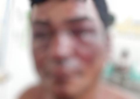 Homem tem rosto deformado ao sofrer 'cobrança' de suposto traficante em Manaus