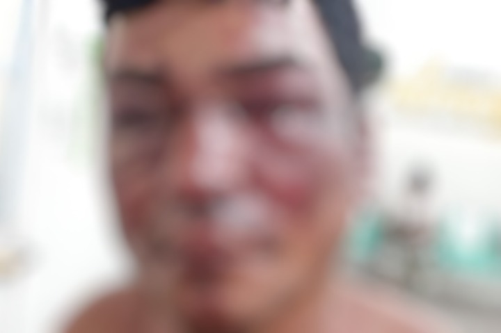 Homem tem rosto deformado ao sofrer 'cobrança' de suposto traficante em Manaus