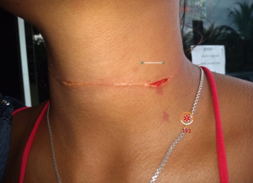 Mulher tem pescoço cortado ao ficar presa em linha de cerol no Amazonas