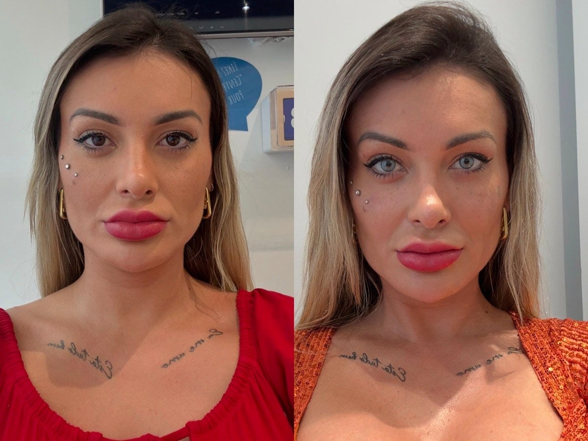 Andressa Urach passa por cirurgia para mudar a cor dos olhos 