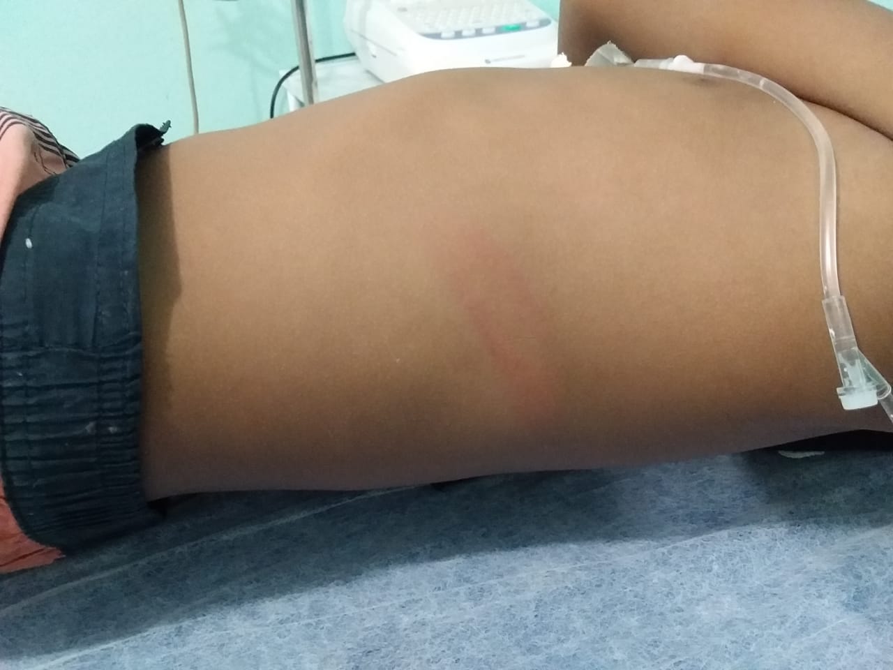 Menino de 8 anos é espancado pelo padrasto ao defender a mãe no Amazonas