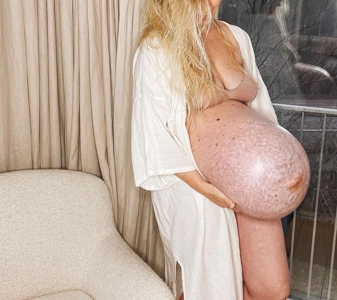 Mulher choca web com barrigão de trigêmeos; médica explica o caso