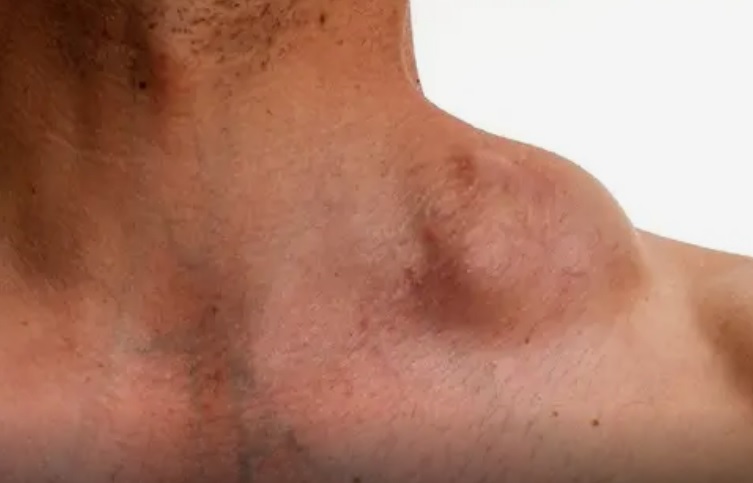 Brasil deve ter 12 mil novos casos de linfoma não Hodgkin neste ano, estima Inca