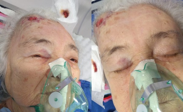 Idosa com covid cai de leito no 28 de Agosto e família denuncia negligência