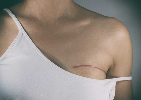 Pacientes submetidos a mastectomia terão direito a acompanhante em hospital