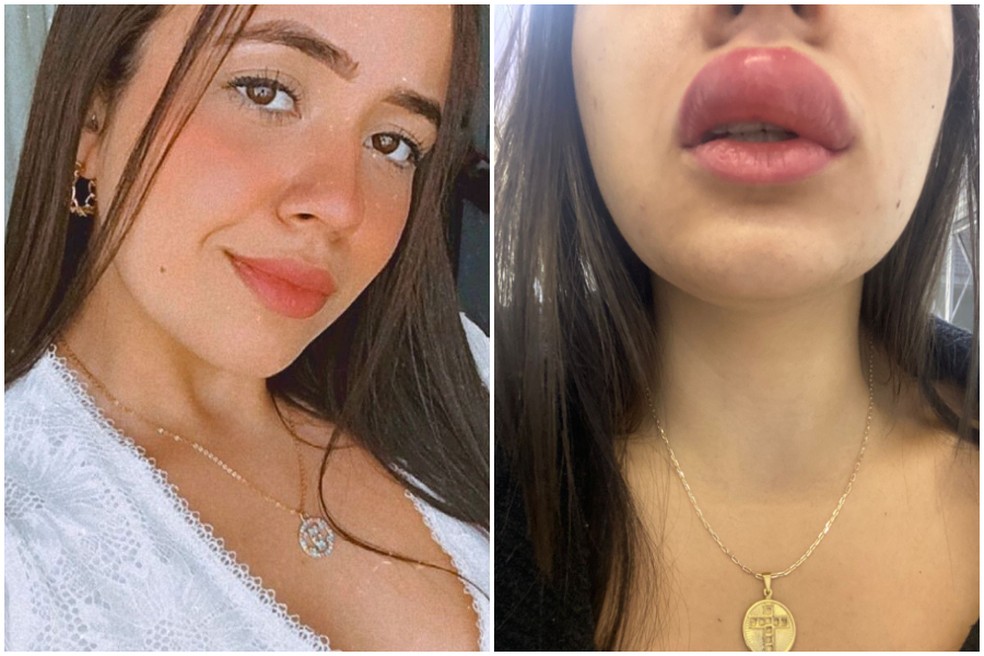 Mulher tem boca deformada após ser picada enquanto dormia