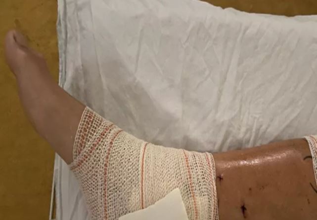 Triatleta leva mais de 50 mordidas durante ataque de pitbulls