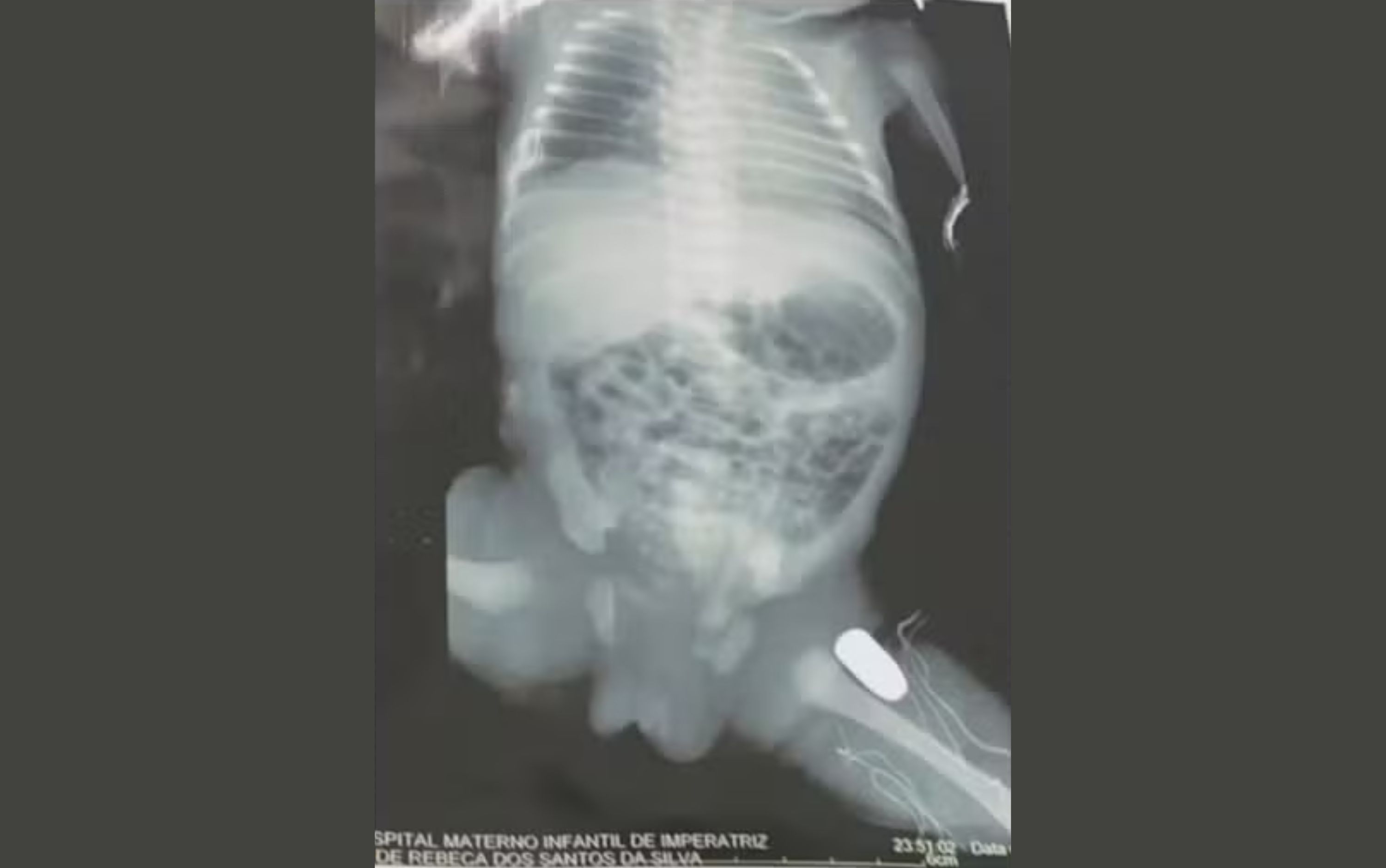 Grávida leva tiro na barriga durante assalto e bala fica alojada em bebê