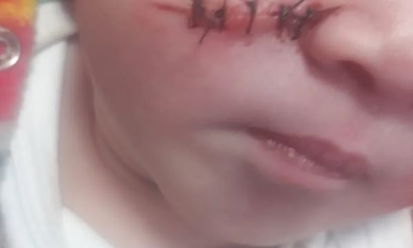 Bebê tem rosto cortado por médico durante cesárea