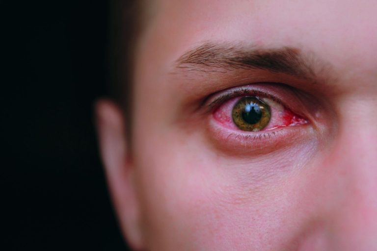 Clima seco e pandemia aumentam casos de olho seco