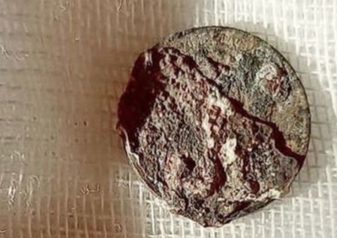 Médicos retiram moeda inserida há 53 anos em nariz de russo 