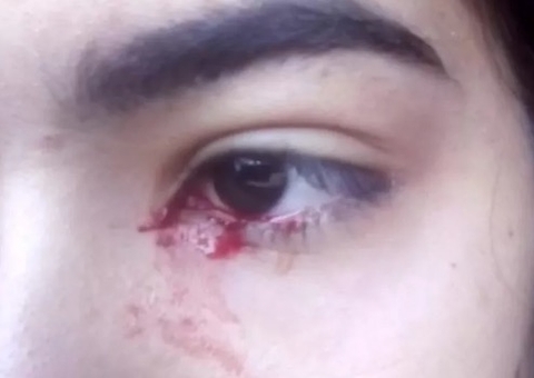 Adolescente intriga moradores de cidade ao 'chorar sangue' 