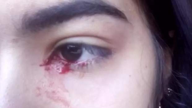 Adolescente intriga moradores de cidade ao 'chorar sangue' 