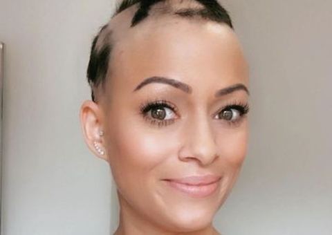 Mulher quase fica careca após colocar DIU