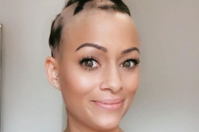 Mulher quase fica careca após colocar DIU