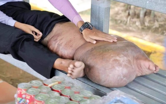 Homem fica com perna deformada após picada de mosquito: 'pata de elefante'