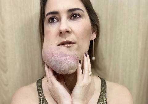 Com distúrbio facial raro, brasileira ganha destaque internacional