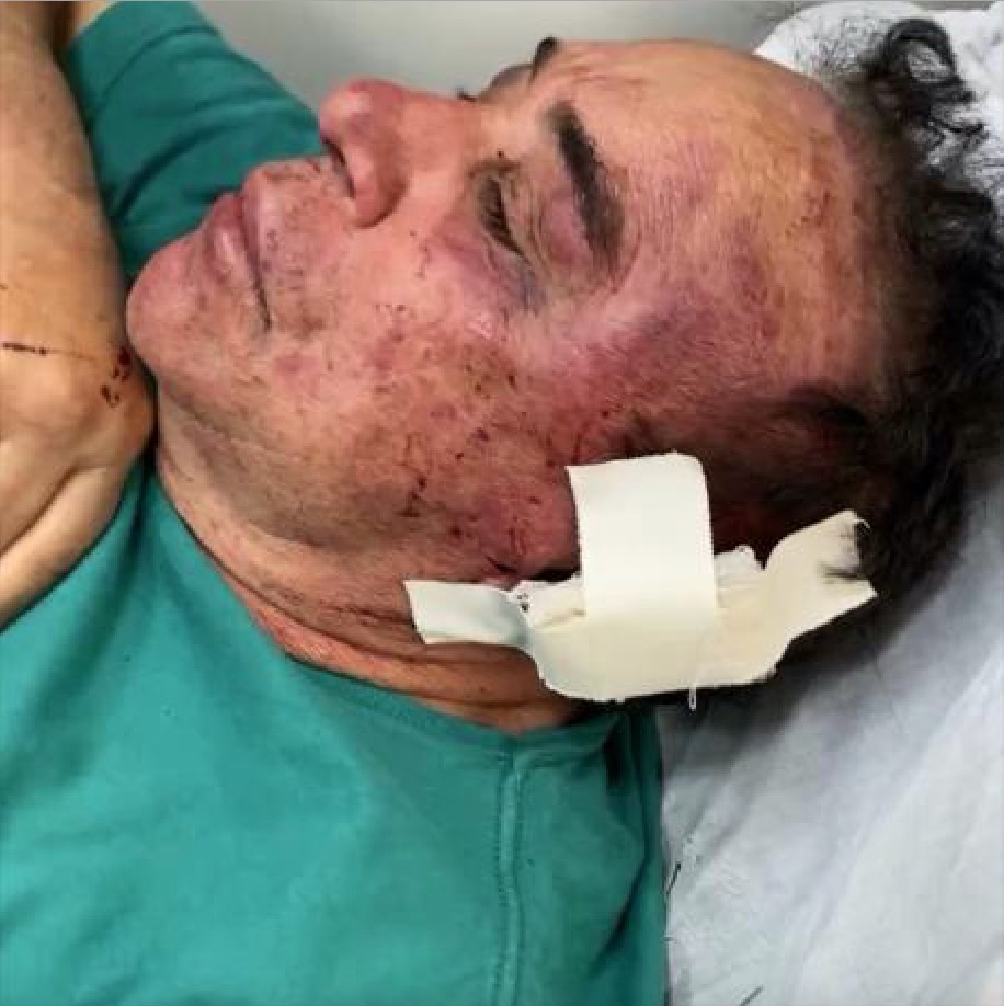 Candidato a prefeito tem casa invadida e é espancado por bandidos