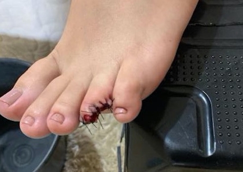 Estudante fica sem o dedo e a sola do pé durante ataque de piranhas