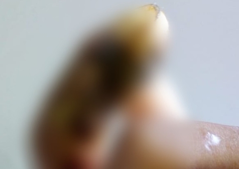 Jovem tem dedo da mão necrosado após ser picado por aranha