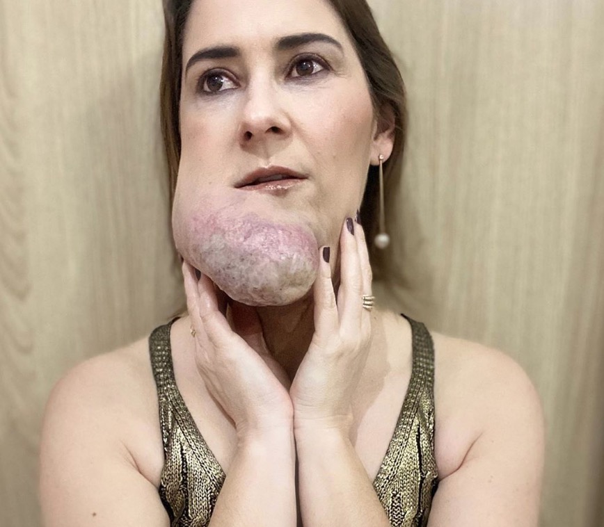 Com distúrbio facial raro, brasileira ganha destaque internacional