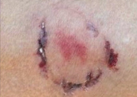 Adolescente de 16 anos é mordida pelo marido ao defender pitbull 