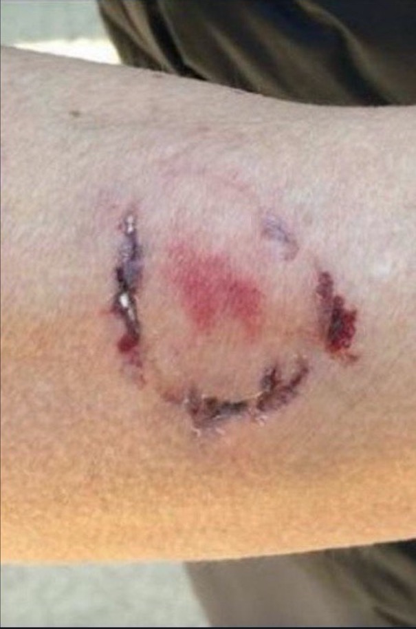 Adolescente de 16 anos é mordida pelo marido ao defender pitbull 