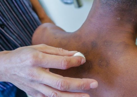Novo tratamento para hanseníase será disponibilizado pelo SUS