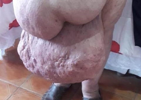 Idoso com hérnia de 30 kg luta há quatro anos por cirurgia