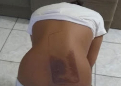 Menina de 7 anos dorme com celular e acorda com queimadura nas costas