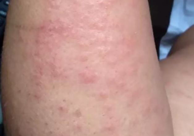 Surto de doença misteriosa atinge moradores de cidades em Pernambuco