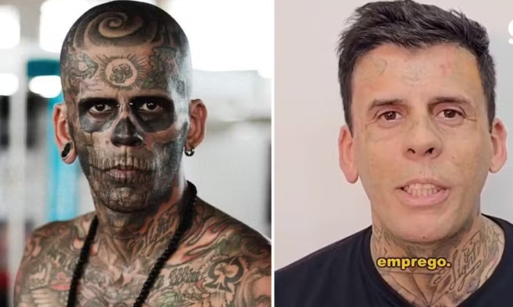 'Mais tatuado do Brasil' surge irreconhecível após sessão de laser
