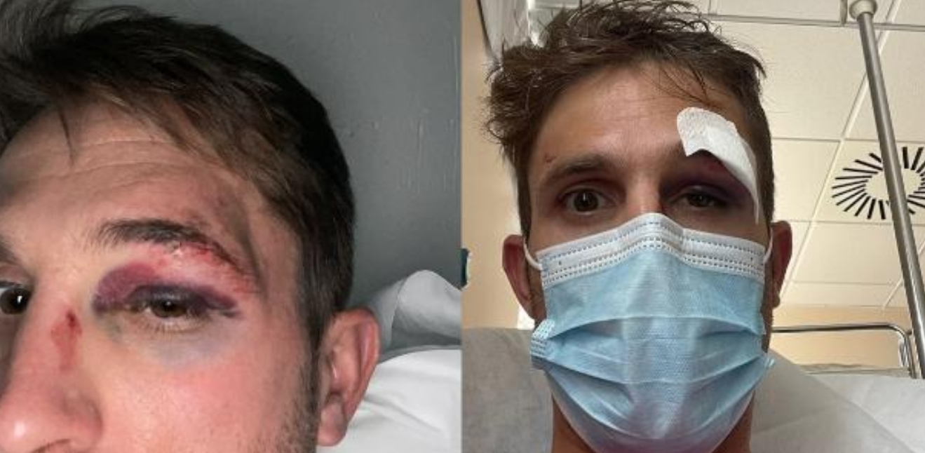 Ciclista é atropelado em treino para Volta da Espanha e mostra lesões