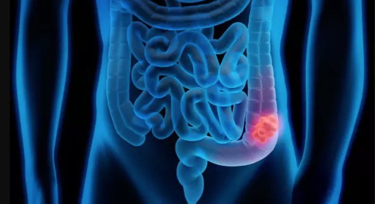 Câncer colorretal já é segunda doença mais letal do Brasil