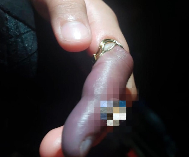 Criança prende argola na mão e quase tem dedo necrosado em Manaus