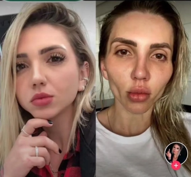 'Minha cara caiu', influencer desabafa sobre bichectomia; veja resultado