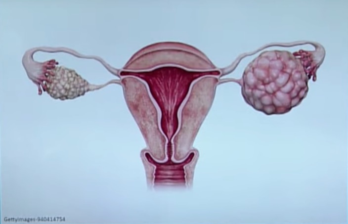 Câncer de Ovário: saiba mais sobre a doença que vitimou a atriz Eva Wilma