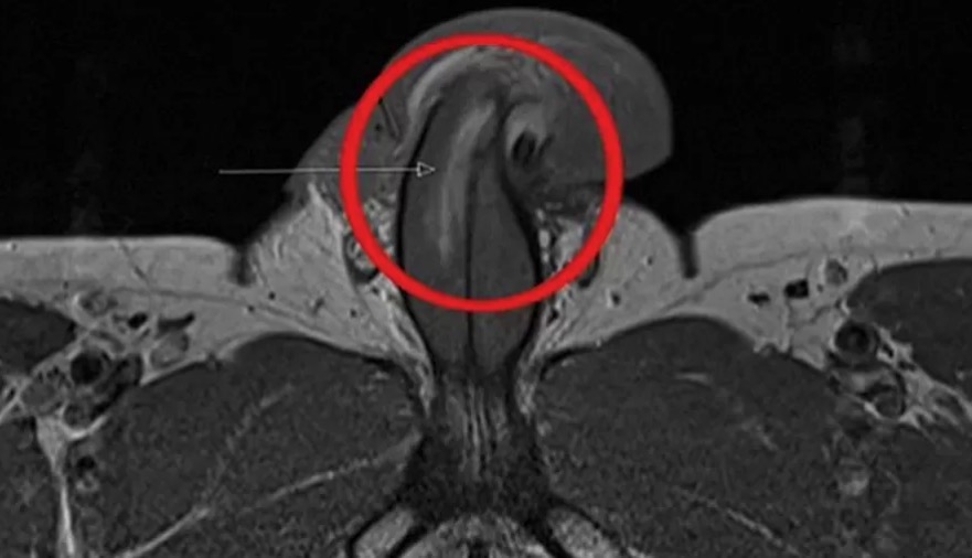 Homem fratura pênis durante sexo em caso inédito; veja foto