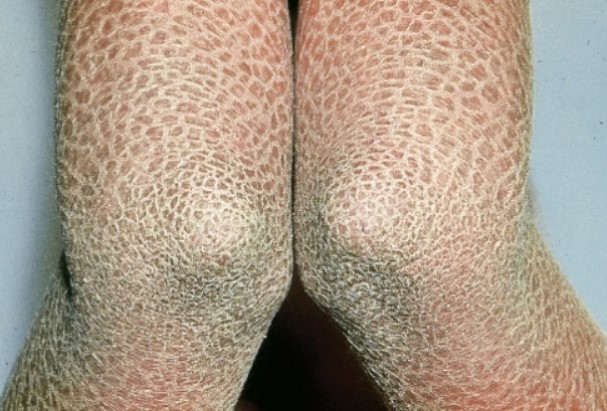 Menina fica com pele 'dura' como pedra devido a doença rara