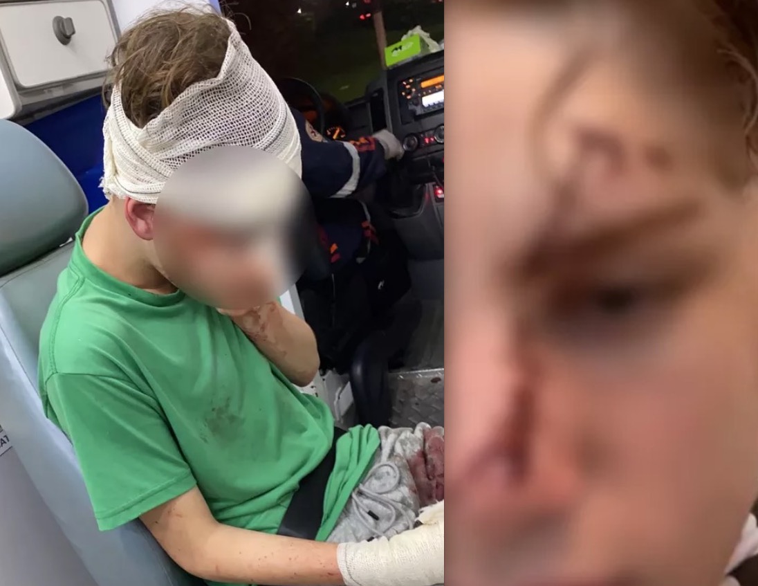 Influencer de 16 anos tem rosto desfigurado após levar garrafada