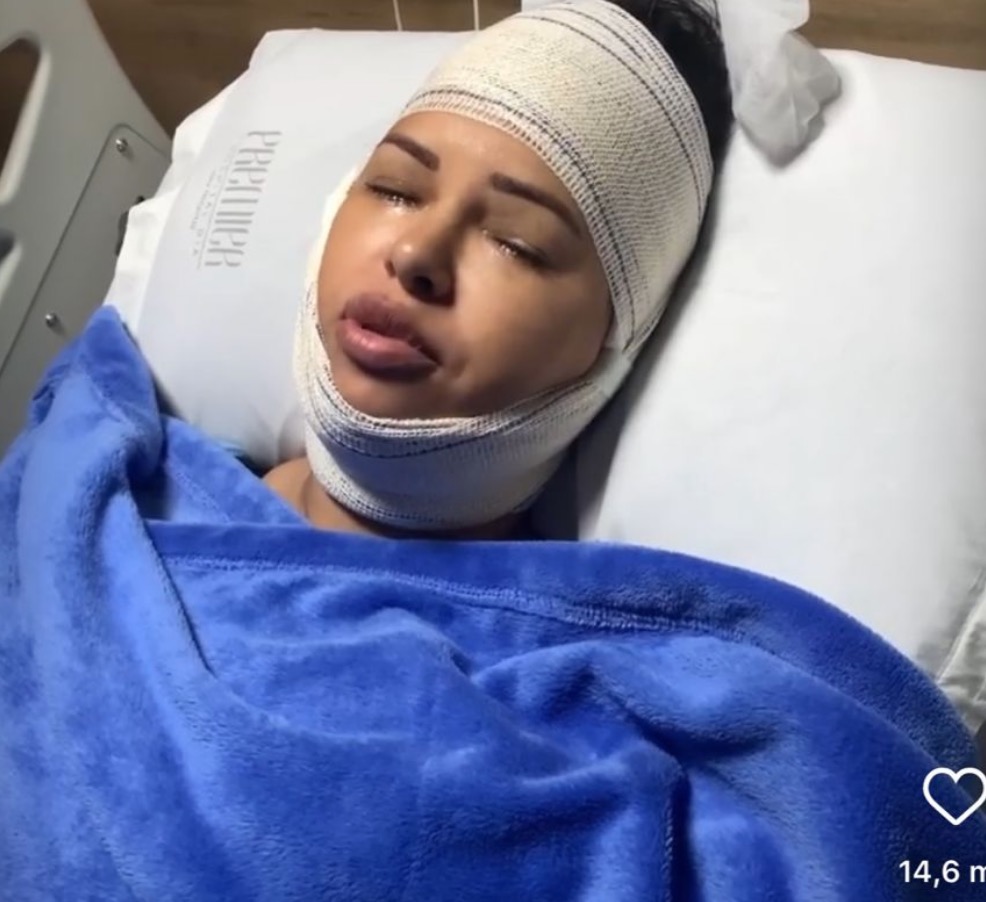 Ex-bbb Ariadna faz recauchutagem e mostra fotos após 3 cirurgias plásticas 