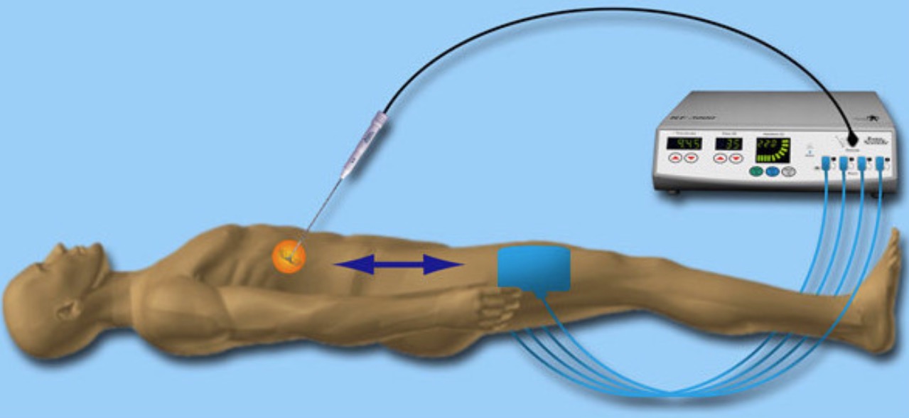 Ablação por radiofrequência é opção eficaz no tratamento de tumores