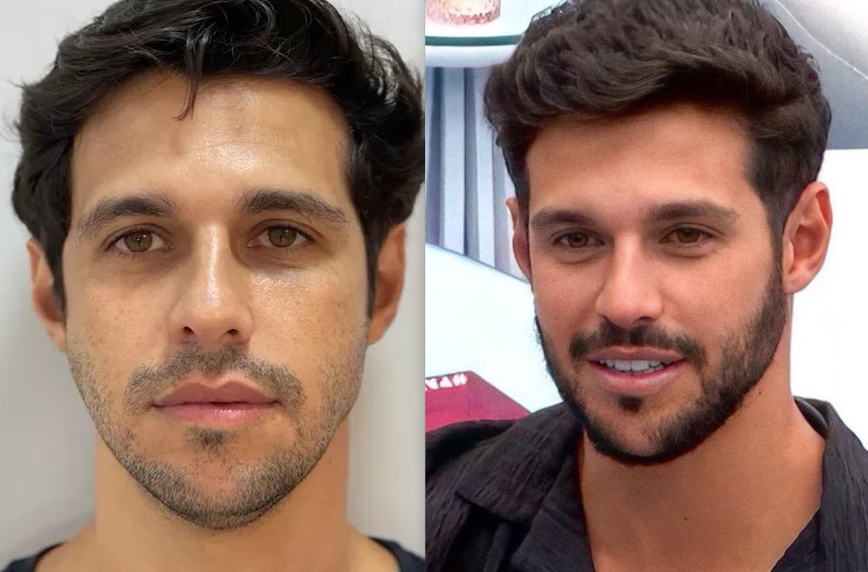 Rodrigo Mussi do BBB 22 fez harmonização facial; Veja antes e depois 