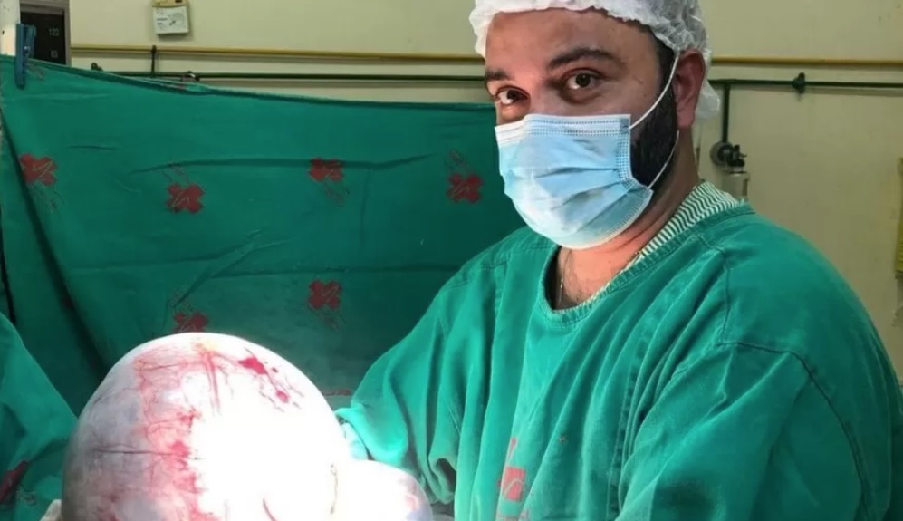 Cisto gigante de 8kg é retirado em cirurgia no Brasil